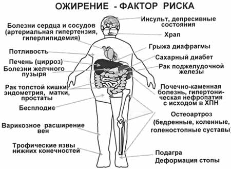 Ожирение опасно для жизни рекомендации Ожирение опасно для жизни рекомендации